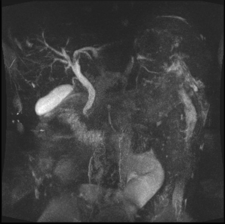 Imaging and Image-Guided Treatment of Biliary Tract Diseases